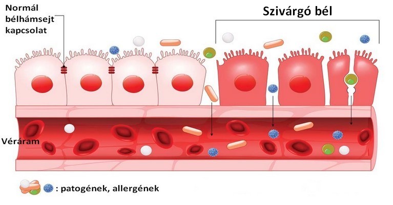 szivárgó bél